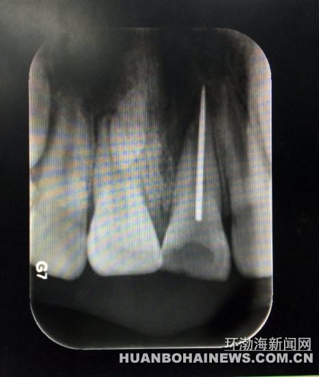 X光片显示缝衣针扎入牙齿根管。